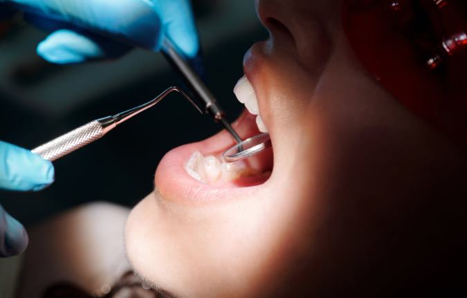 стоимость зубных имплантов в турции